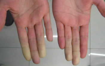 Lupus, bệnh nguy hiểm tấn công phụ nữ trẻ