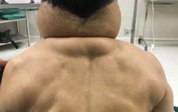 Một người đàn ông biến thành người khổng lồ sau nhiều năm nghiện rượu